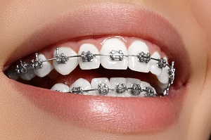 Aparat dentar metalic